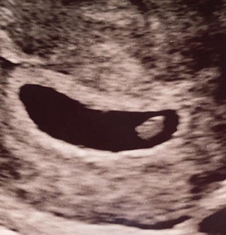 The six week scan showed a strong heartbeat