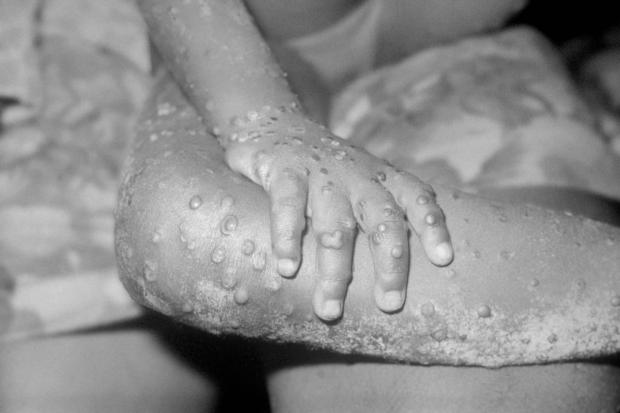Barry And District News: The monkeypox virus can be spread in a number of ways. Picture: PA